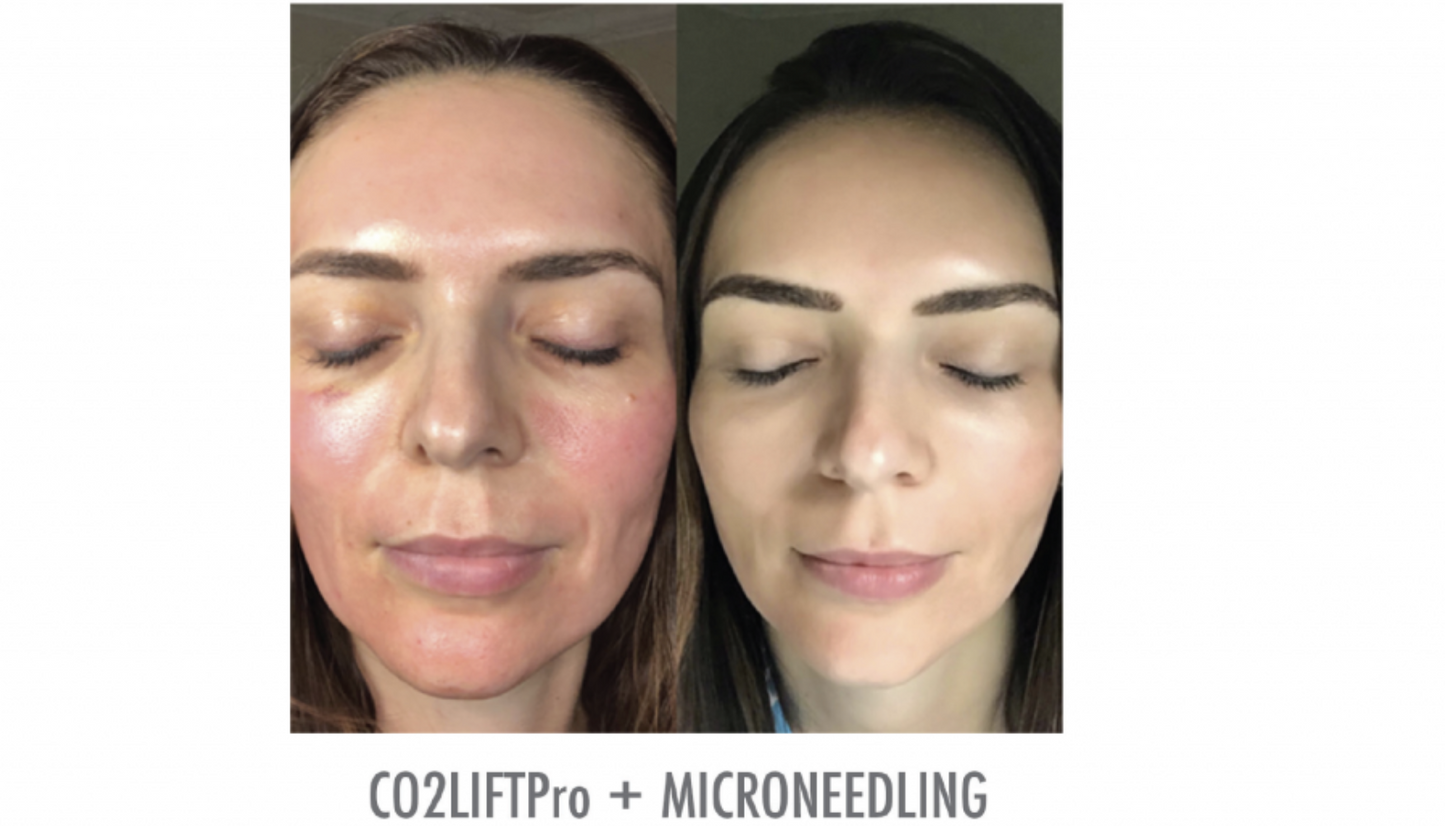 CO2 Lift Pro Mask - The Curated Skin Studio