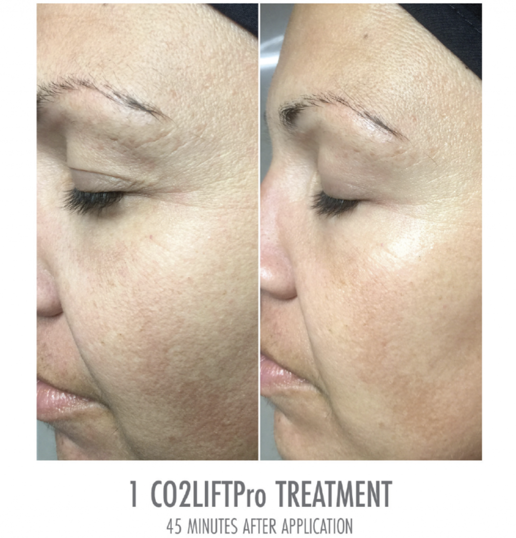 CO2 Lift Pro Mask - The Curated Skin Studio