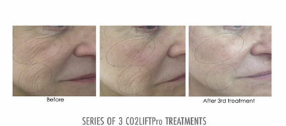 CO2 Lift Pro Mask - The Curated Skin Studio