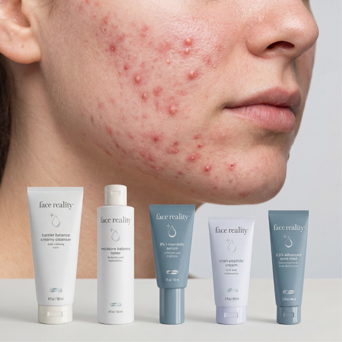 Inflamed Acne System - The Curated Skin Studio